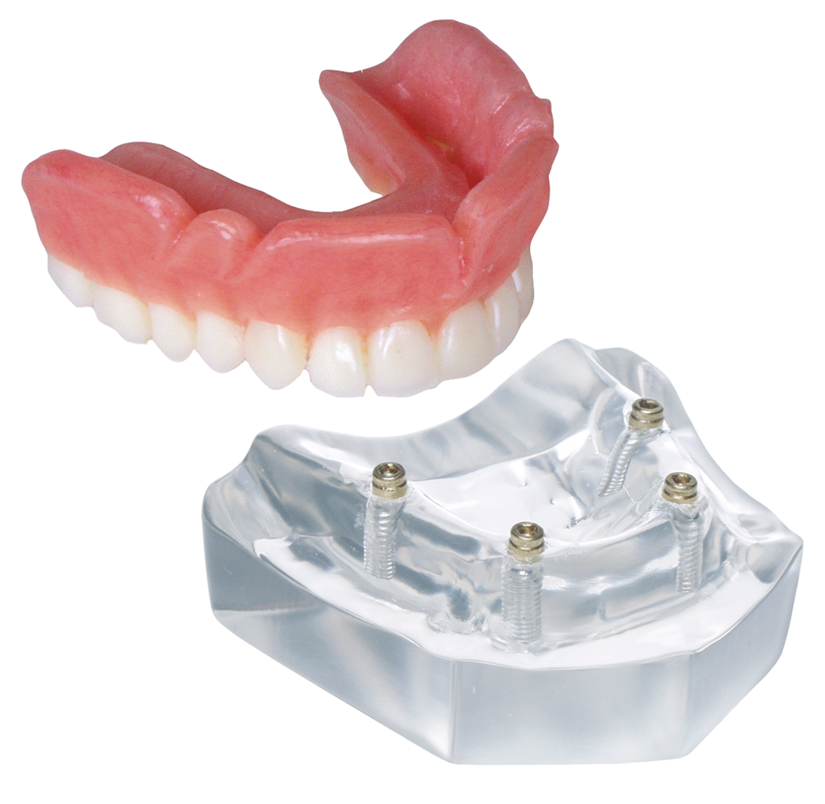 Overdenture Attachment