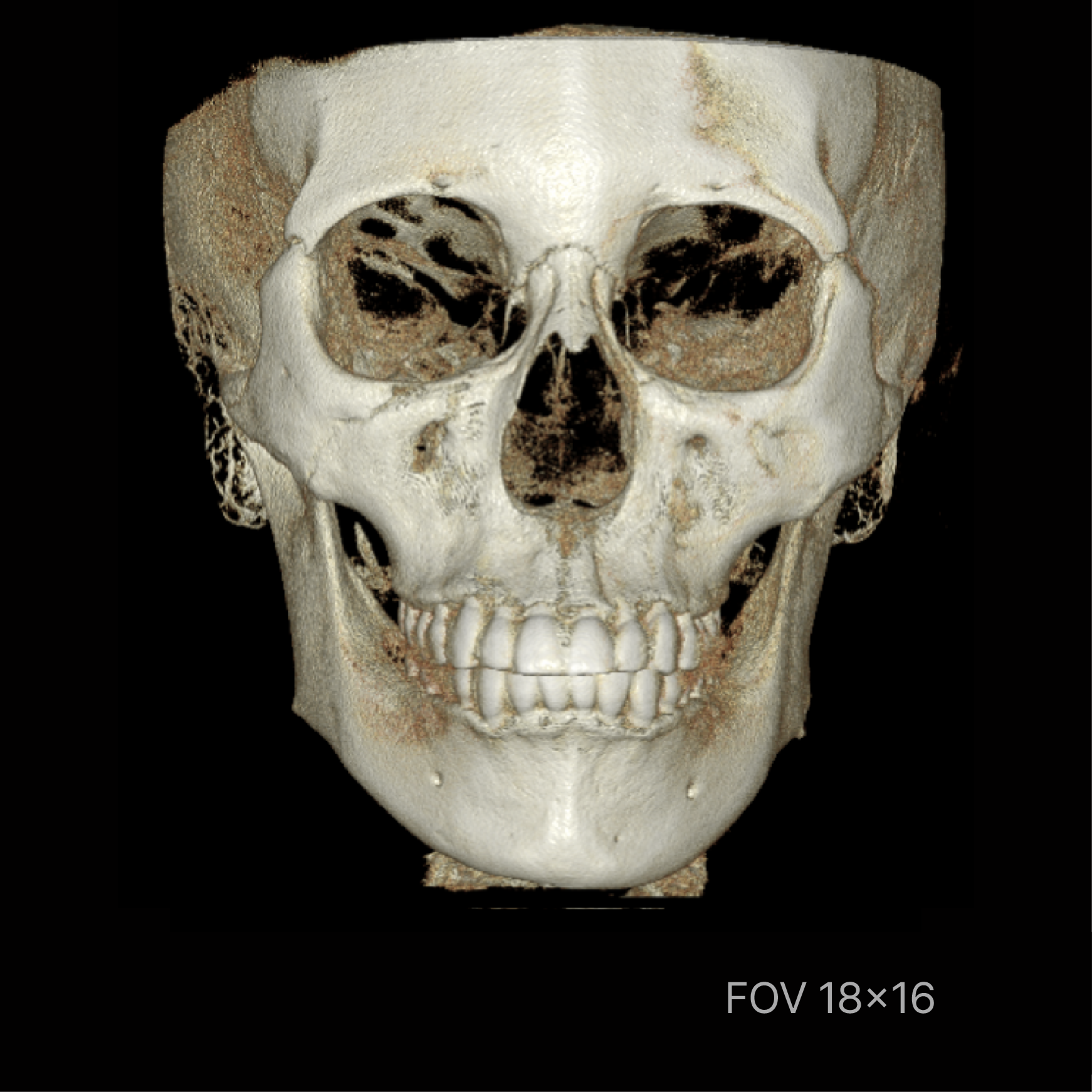 Rayscan Vision 18 FOV 18x16