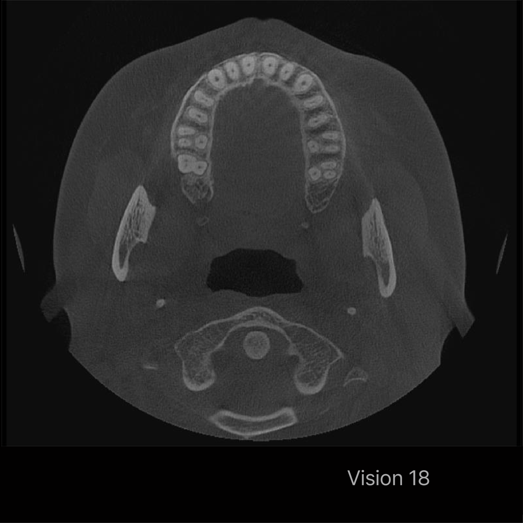 Rayscan Vision 18 FOV 18x16