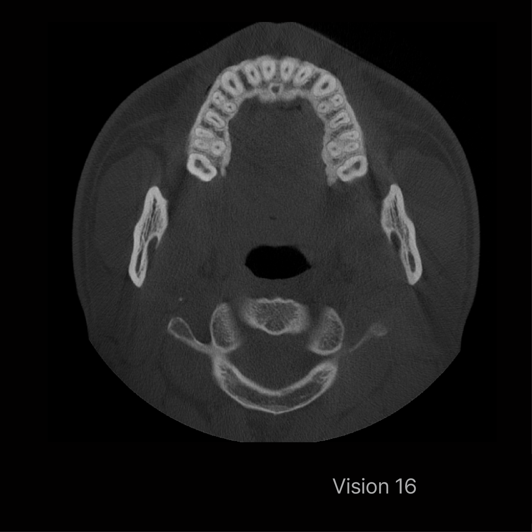 Rayscan Vision FOV 16x10 (AP160)