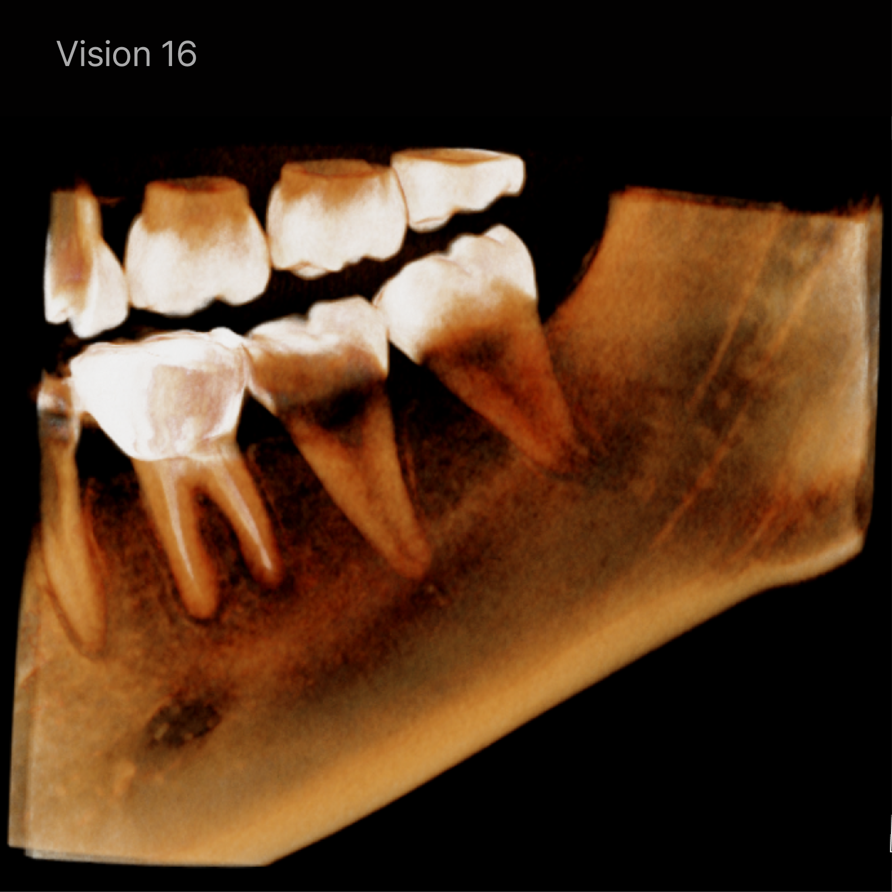 Rayscan Vision FOV 16x10 (AP160)