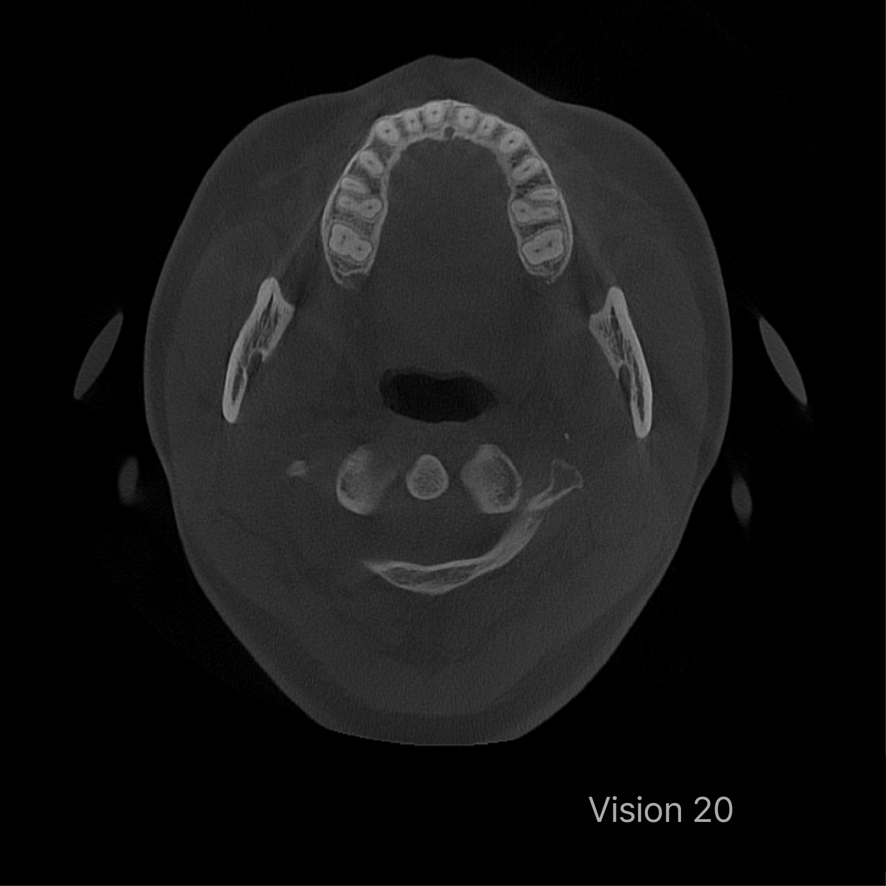 Rayscan Vision 20